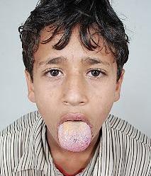 عمار عبدالله يمد لسانه بعد علاجه 	(خاص - «الراي»)