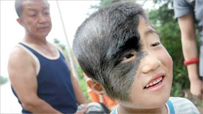 وحمة مشعرة على وجنة آن كي