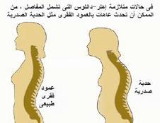 تحدب العمود الفقري وآلام العضلات والمفاصل بفعل آثار توقف عمل المبيض