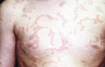 أرتيكاريا البرد منتشرة في أيام الشتاء