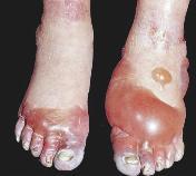 عضة الصقيع عند التعرض للبرد الشديد