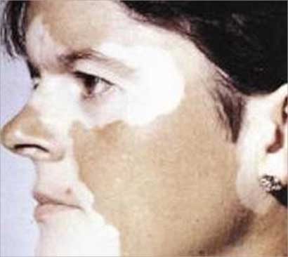 ليس المقصود بالأبرص مريض البهاق