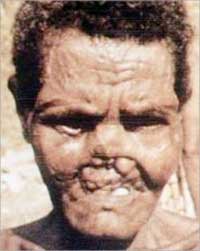 من معجزات المسيح الطبية شفاء مريض الجذام