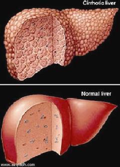 هل تحل صناعة الأعضاء بالخلايا الجذعية كارثة تليف الكبد بسبب فيروس «C» ؟
