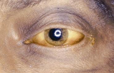 اصفرار بياض العين من أعراض الفشل الكبدي