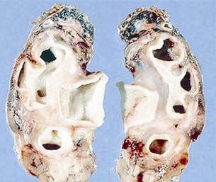 التهاب كبيبات الكلى