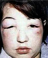 انتفاخ الوجه خصوصا حول العينين من أعراض التهاب كبيبات الكلى