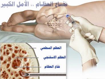 يُعالج سرطان الدم القاتل في المملكة العربية السعودية بزراعة نخاع العظم