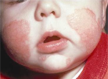 حساسية الجلد ... حكة وطفح جلدي