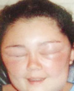 وجه المراهقة منتفخاً كالبالون من تأثير الصبغة