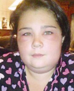 ... وبعض آثار الانتفاخ ما زالت متبقية على الرغم من تماثلها للشفاء