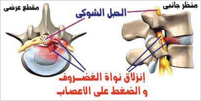 آلام الظهر أشهر أمراض العصر بسبب تغير أسلوب ونمط الحياة