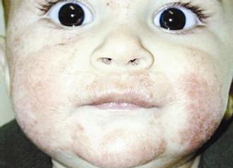 حساسية الجلد في هيئة الاكزيما عند الأطفال