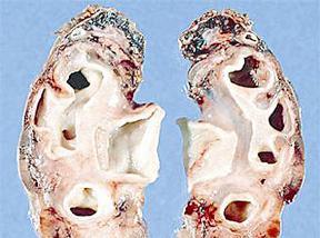 التهاب كبيبات الكلى الحاد