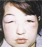 انتفاخ الوجه من اعراض التهاب الكلى