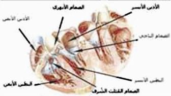 الحمى الروماتيزمية ألهبت صمامات القلوب وأتلفتها