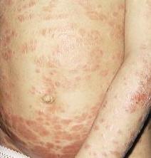 الارتيكاريا «حساسية الجلد» مزعجة