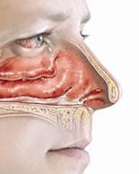 حساسية الأنف أكثر أنواع الحساسية انتشارا في الربيع