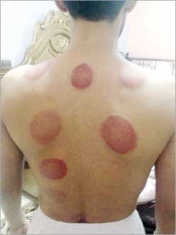  أثر كاسات الهواء