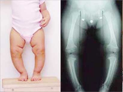 u0625u0635u0627u0628u0629 u0627u0644u0623u0637u0641u0627u0644 u0628u0644u064au0646 u0627u0644u0639u0638u0627u0645