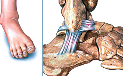 التواء مفصل القدم بسبب القفز والجرى