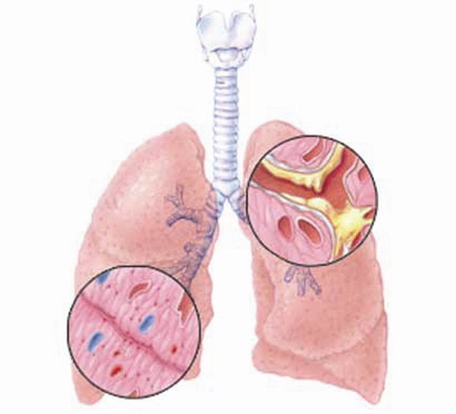 نبات اليانسون يحمي ويعالج أمراض الجهاز التنفسي
