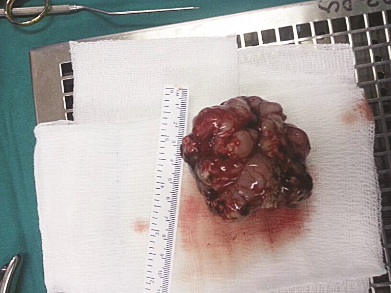 كتلة الورم بعد استئصالها