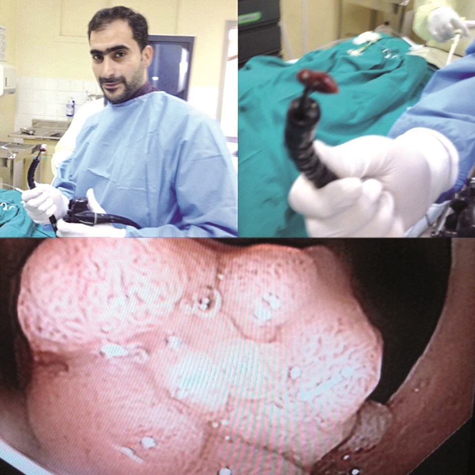 ...وخلال استئصال أحد أورام القولون