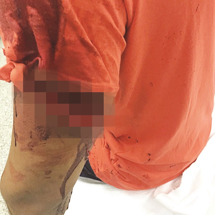 جرح غائر في ذراع الآخر