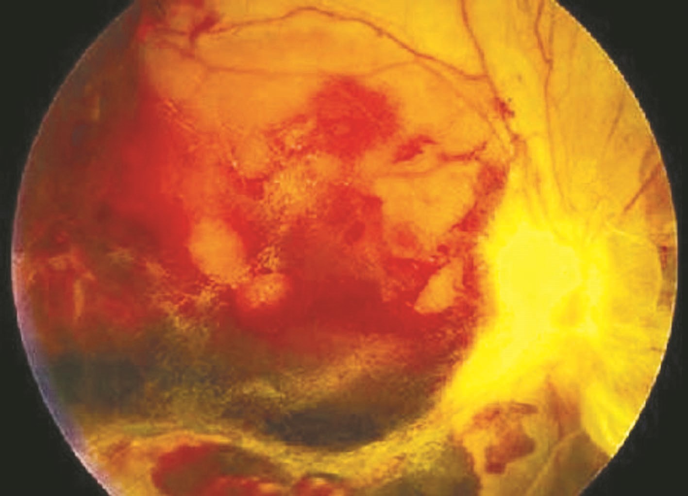 صورة شبكية مصابة باعتلال حاد ناجم عن السكري