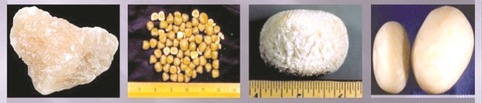 صور لأنواع مختلفة من الحصوات الكُلويّة