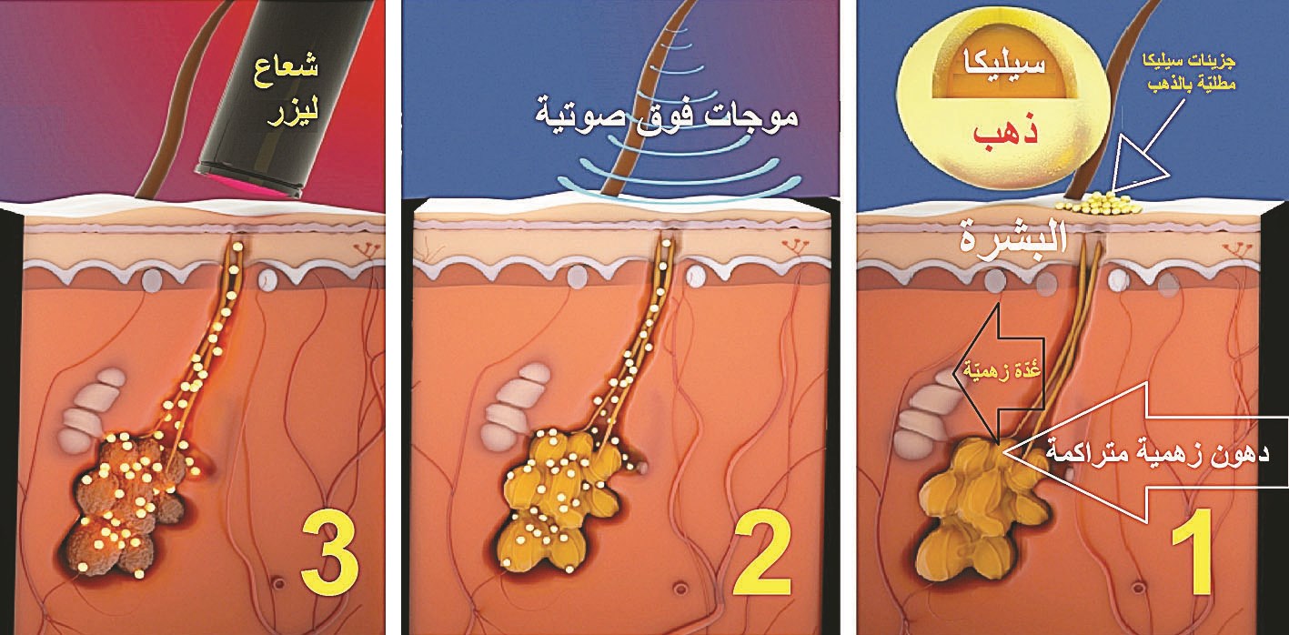 u062eu0637u0648u0627u062a u0639u0645u0644 u0627u0644u0637u0631u064au0642u0629 u0627u0644u062cu062fu064au062fu0629 u0644u0645u0639u0627u0644u062cu0629 u0645u0634u0643u0644u0629 u062du0628 u0627u0644u0634u0628u0627u0628