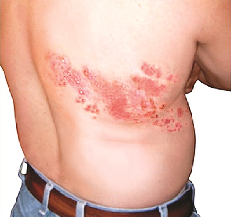 u0645u0631u064au0636 u0645u0635u0627u0628 u0628u0623u0639u0631u0627u0636 u00abu0627u0644u062du0632u0627u0645 u0627u0644u0646u0627u0631u064au00bb