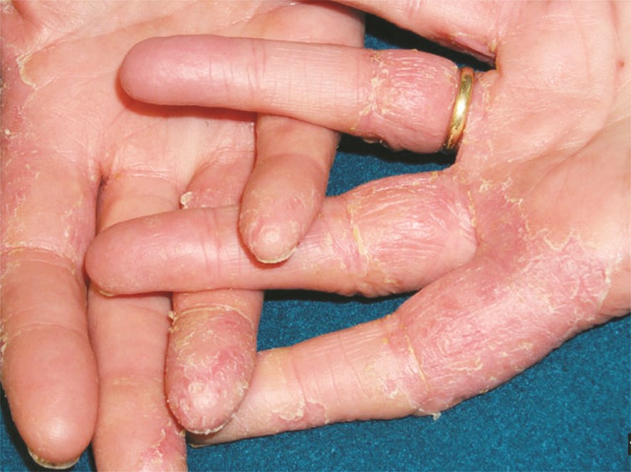 اكزيما اليدين