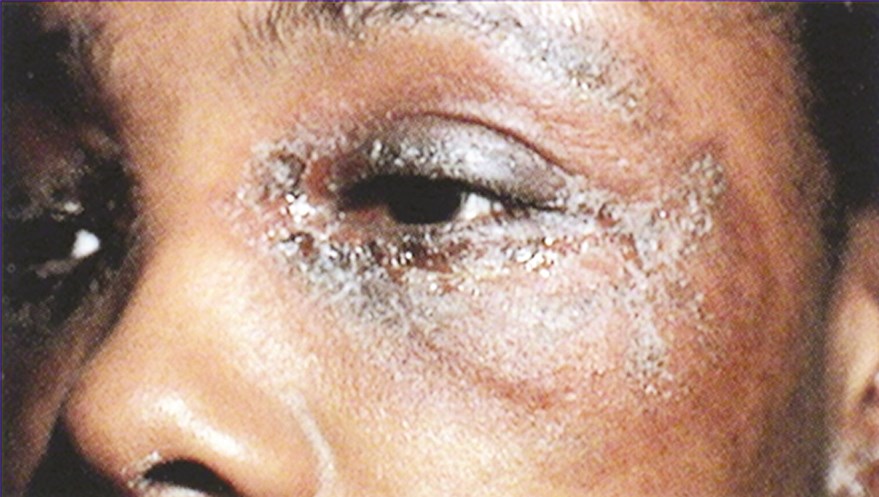 اكزيما الوجه