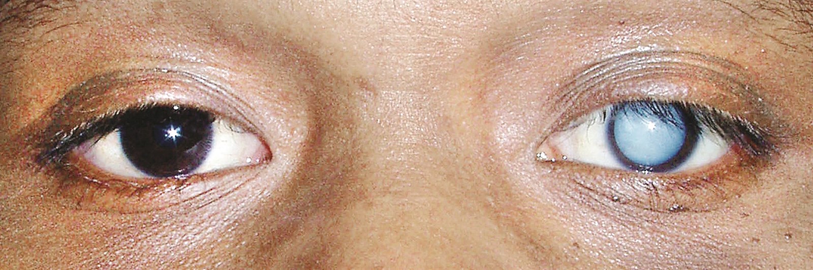 u0645u0631u064au0636 u0645u0635u0627u0628 u0628u0633u062du0627u0628u0629 u0628u064au0636u0627u0621 u0639u0644u0649 u0639u064au0646u0647 u0627u0644u064au0633u0631u0649