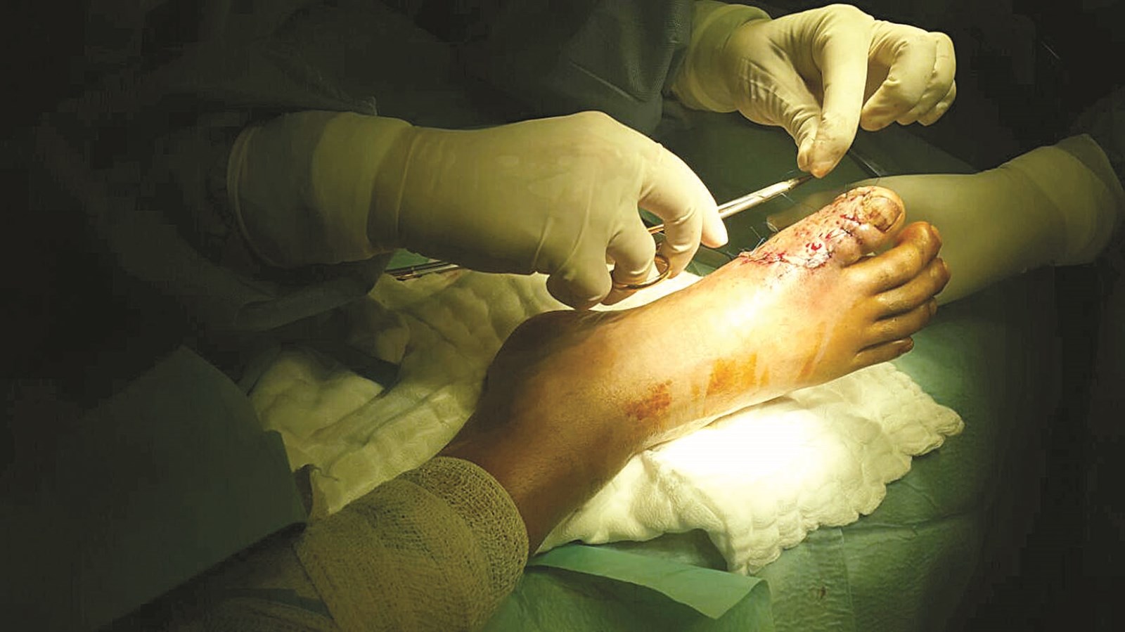 تثبيت الجلد في المرحلة الثانية للعملية