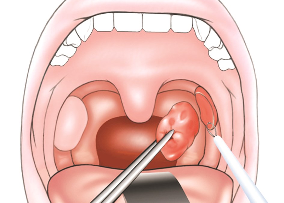 رسم توضيحي يبين إحدى طرق استئصال اللوزتين