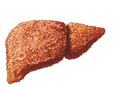 u0643u0628u062f u0645u0635u0627u0628u0629 u0628u0627u0644u0627u0644u062au0647u0627u0628 u0627u0644u0648u0628u0627u0626u064a