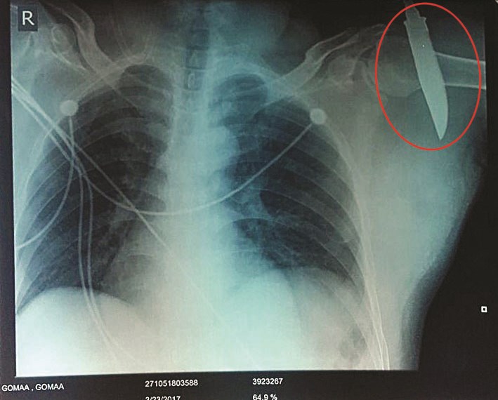أشعة تظهر أداة الجريمة في الكتف اليسرى للمطعون