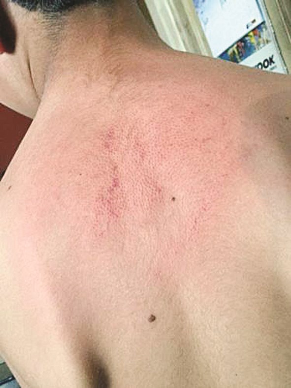 u0622u062bu0627u0631 u0627u0644u0636u0631u0628 u0628u0627u062fu064au0629 u0639u0644u0649 u062cu0633u062f u0627u0644u062au0644u0645u064au0630