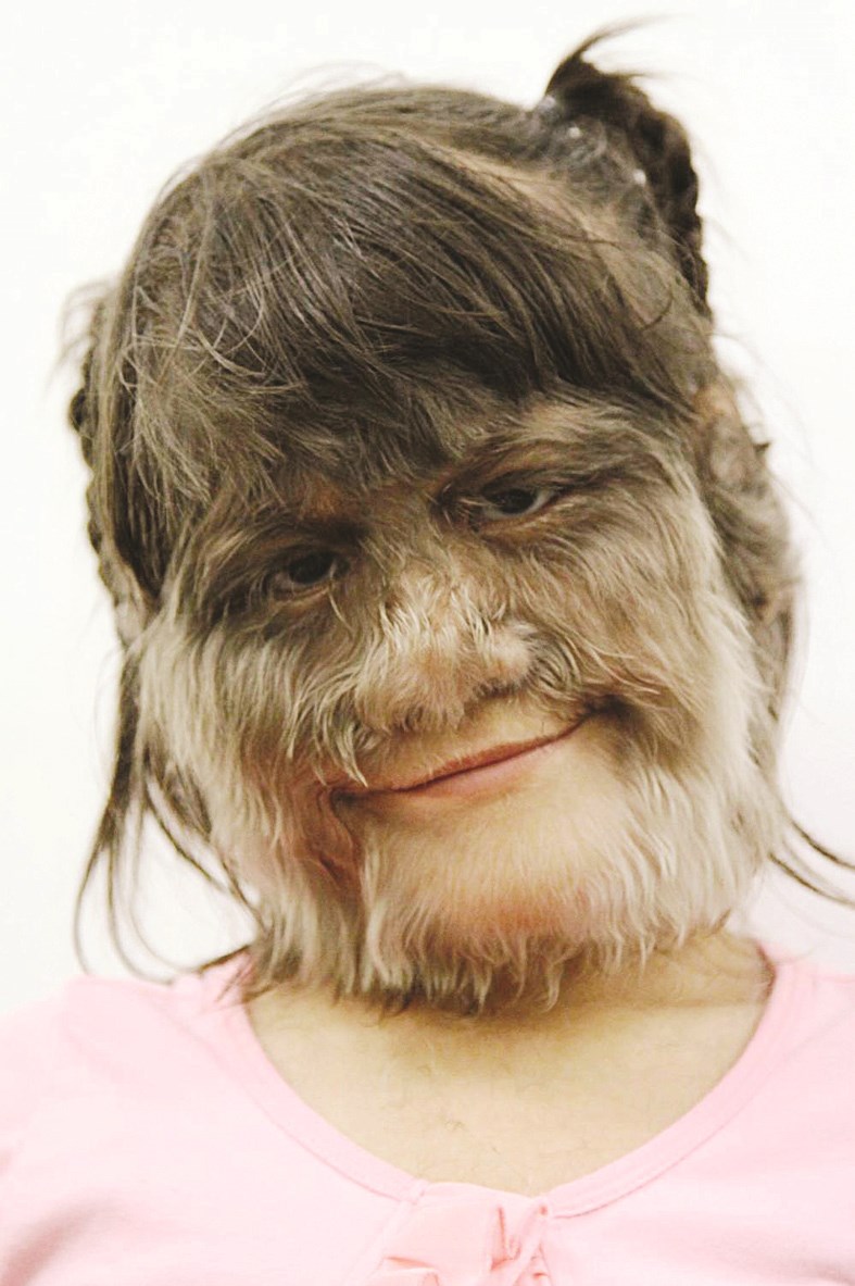 طفلة مستذئبة مصابة بمتلازمة أمبراس