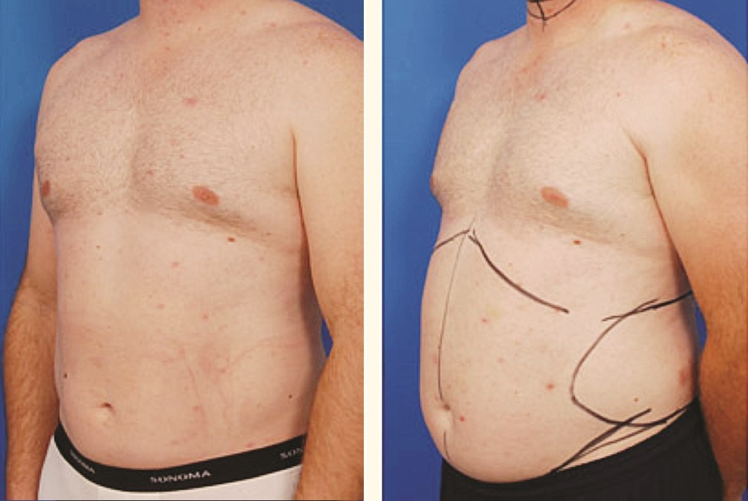 شفط الدهون من البطن... والنتائج