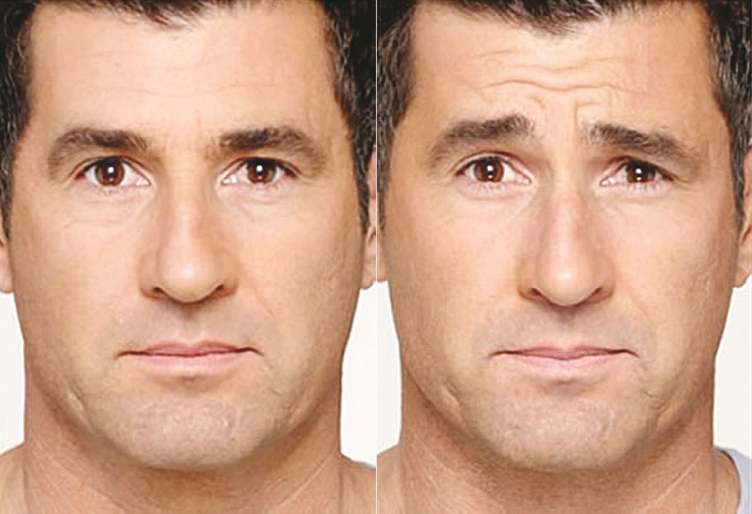 البوتوكس ونتائجه