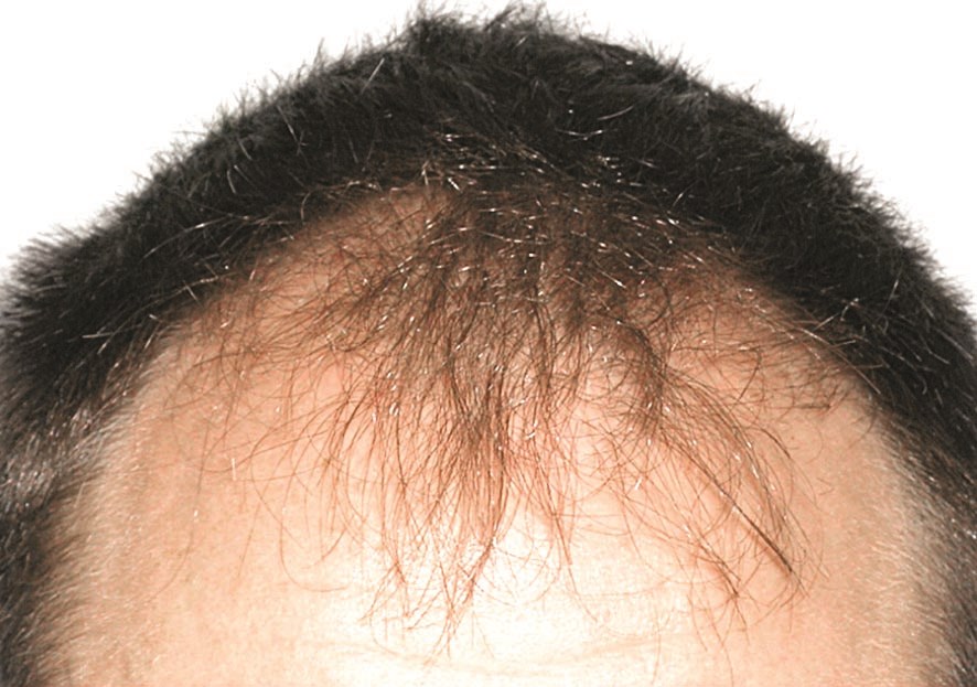 زرع الشعر قبل وبعد