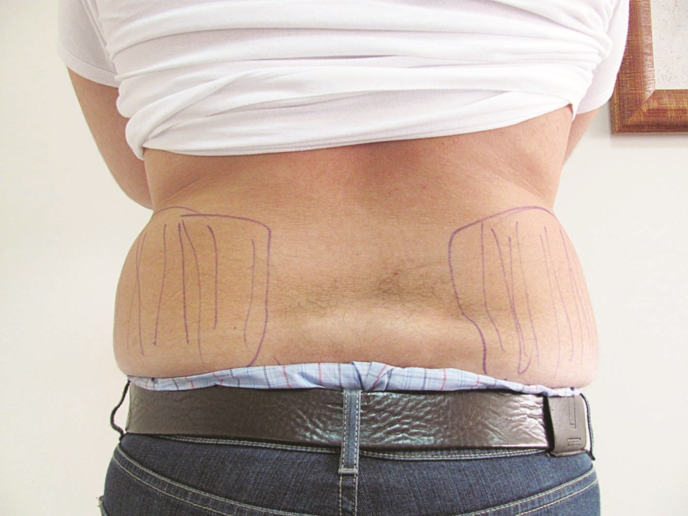 شفط الدهون من الخواصر قبل وبعد