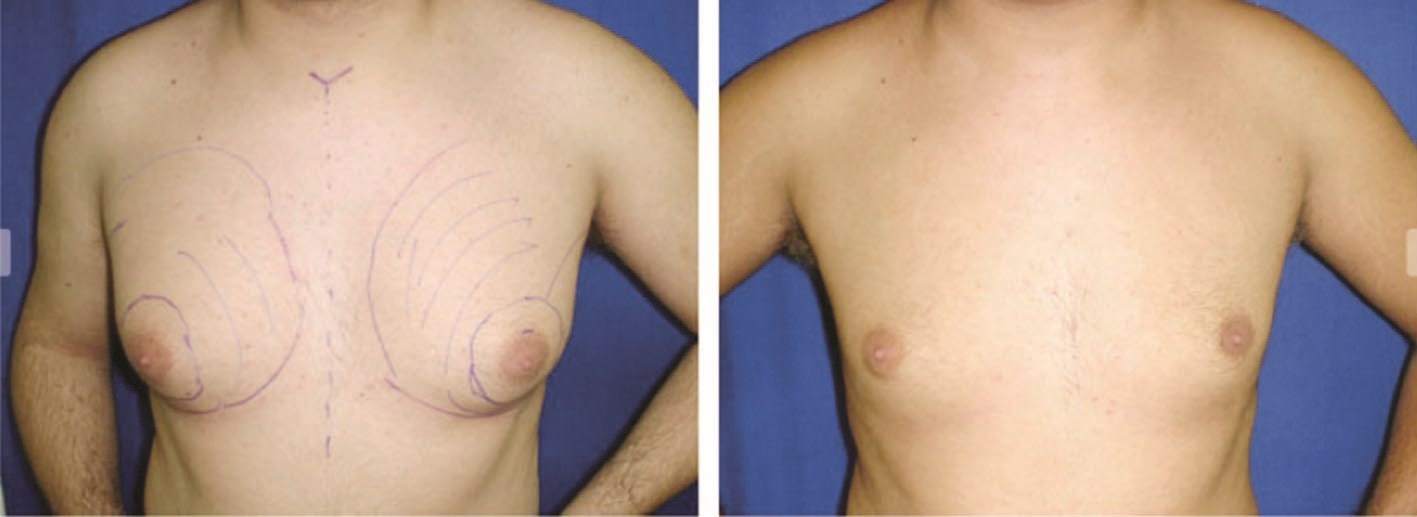 عملية تصغير الصدر... قبل وبعد