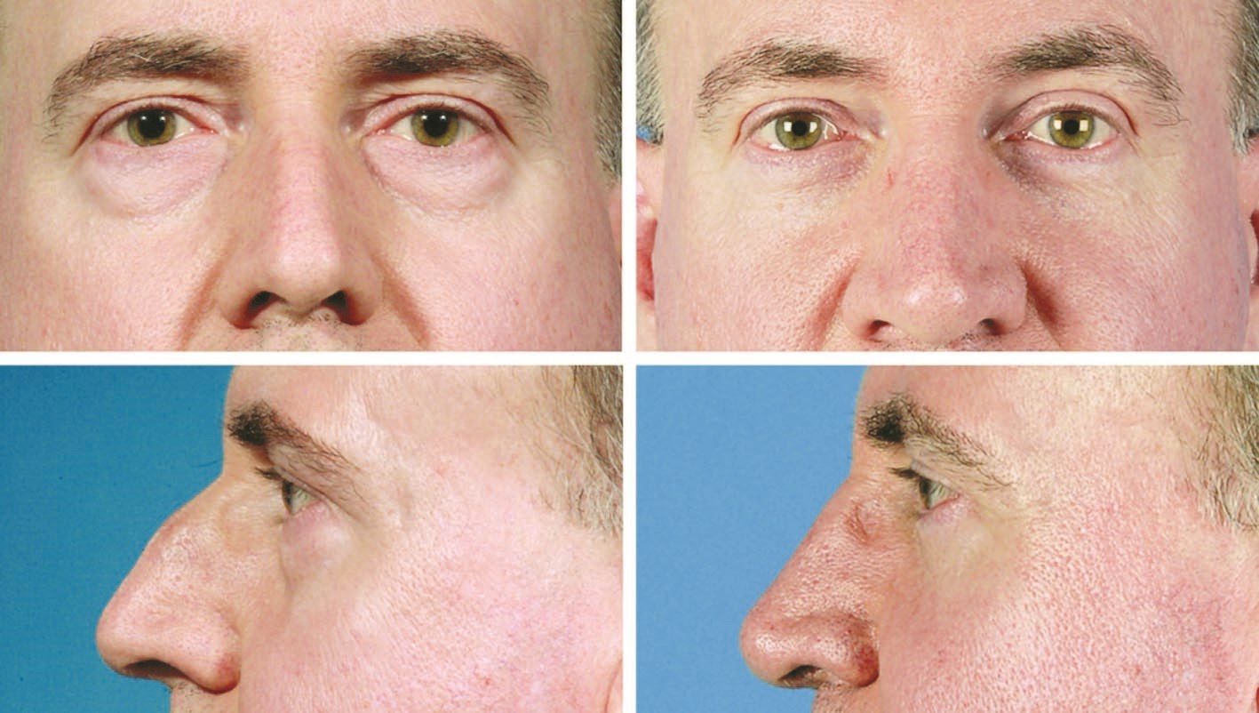 تجميل الأنف قبل وبعد