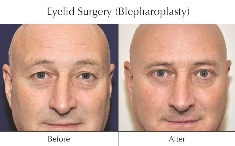 جراحة شدّ الجفون