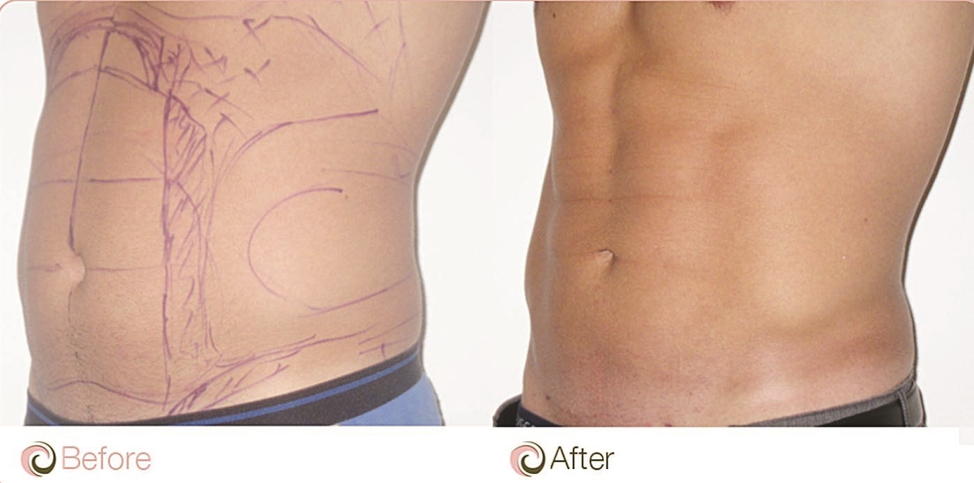 نحت البطن بتقنية الـ VASER